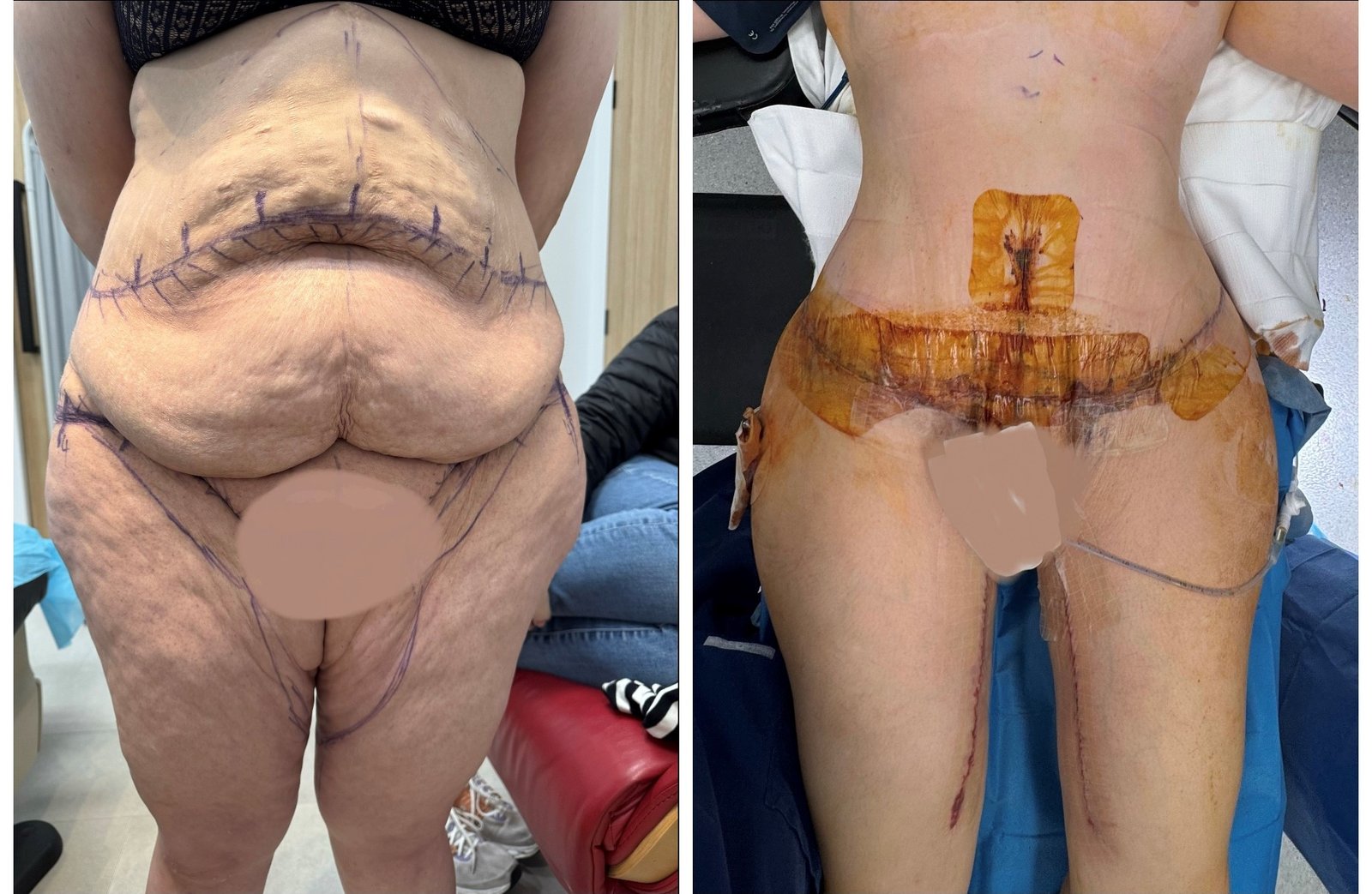 Featured Circumferential Abdominoplasty Result