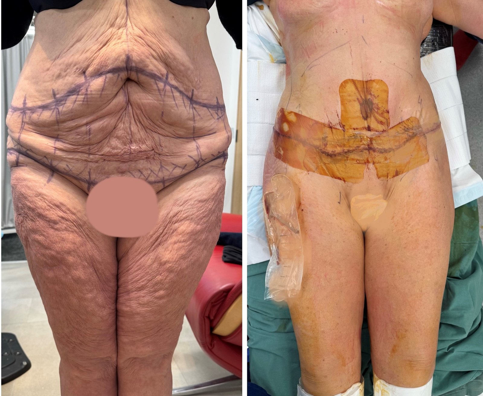 Body Contouring Result - Lower Body Lift