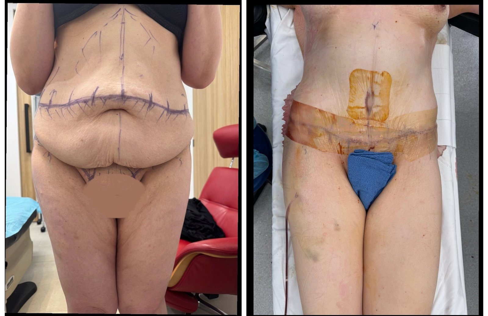 Body Contouring Result - Circumferential Abdominoplasty