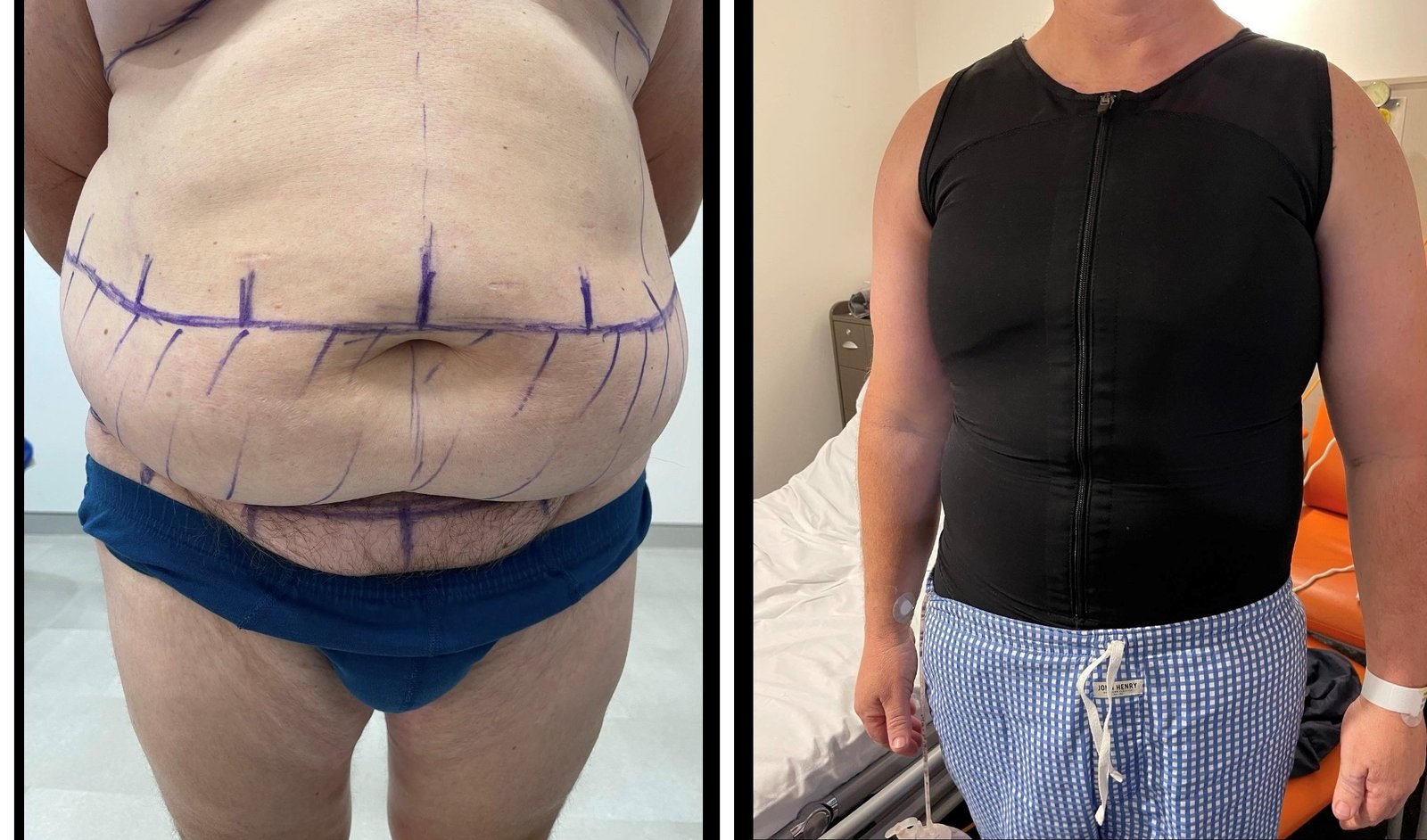 Body Contouring Result - Post Weight Loss Surgery